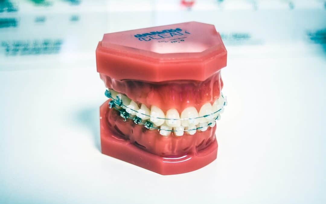 Orthodontic Care: What Are the Signs You Need Braces?