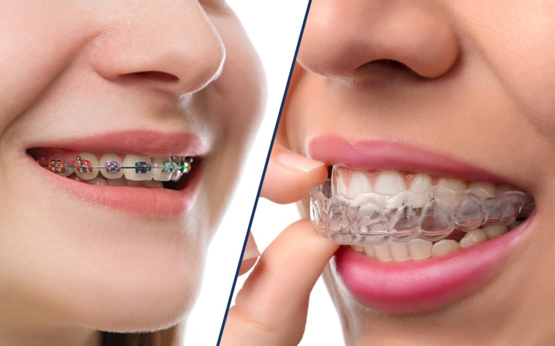 Metal vs Clear Braces: Which One Should You Choose?