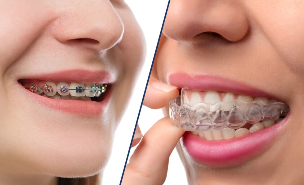 Metal vs Clear Braces North Seattle Orthodontics