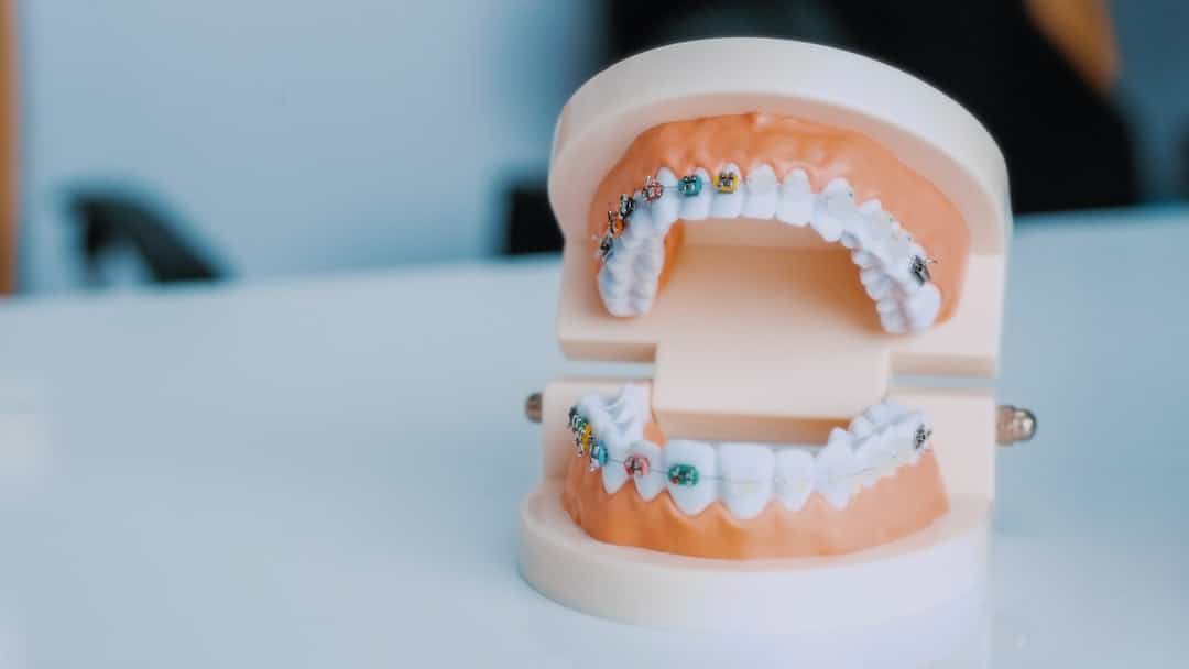 How Long Does It Take to Put on Braces?