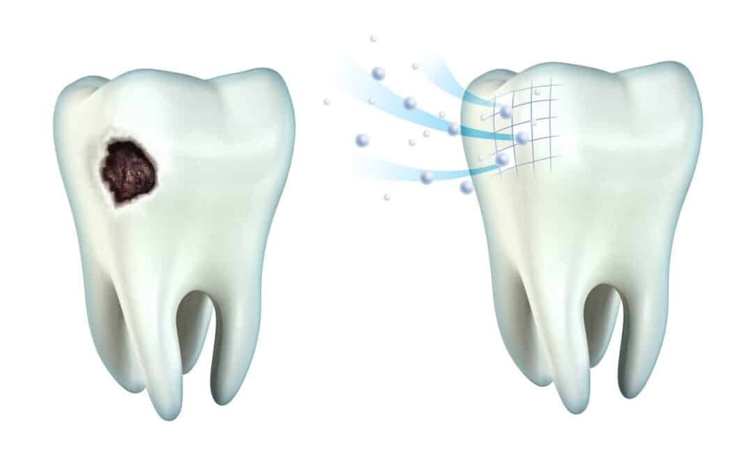 What Are the Pros (And Cons) Of a Composite Filling for My Tooth?